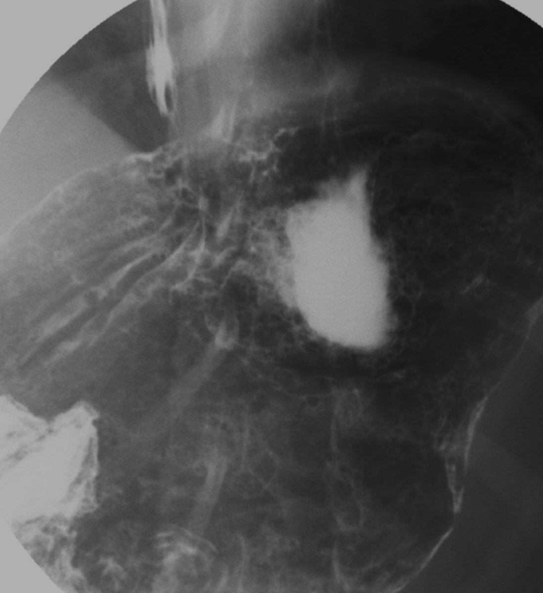 medic_radio's tweet photo. Así se ve una úlcera gástrica en un estudios de serie gastroduodenal; se observa un depósito de contraste con halo radiolucido (edema) con múltiples pliegues gástricos engrosados que confluyen al depósito y forman el nicho ulceroso. #ulceragastrica https://t.co/JFUSTVl5Zc