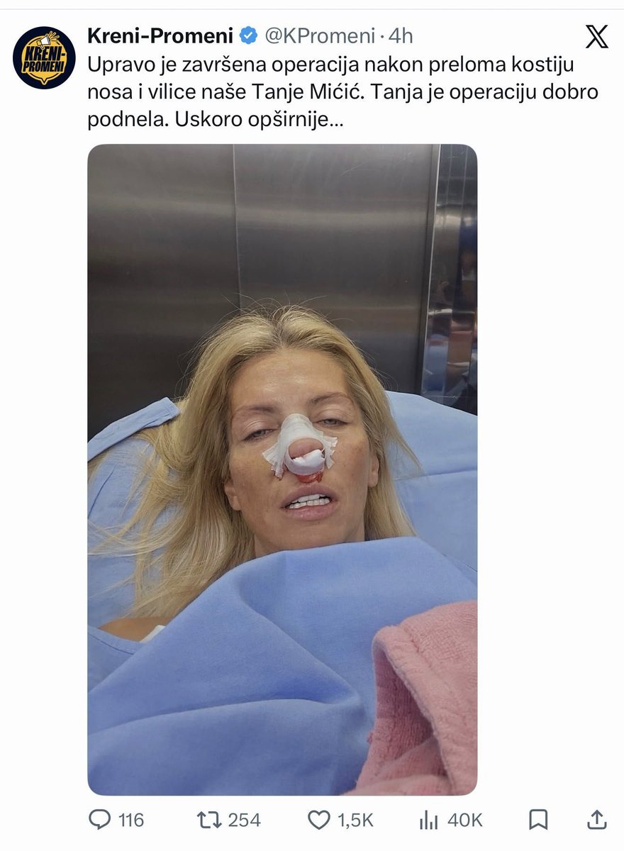 ManjaUhrin's tweet photo. Jel u Turskoj obavljena devijacija ako nije onda nije uspela,i dalje nastavi da dišes samo na usta...sjajno su te umotali nigde modrice nemaš kao posledica postoperativnog zahvata,a i taj kečap što curi jel blagi ili ljuti...poooz https://t.co/Nu8jcm4VOK