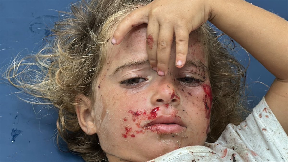 dn_osama_rabee's tweet photo. On this child’s face… the scars that tell the story of Gaza’s pain. https://t.co/9B693eReER