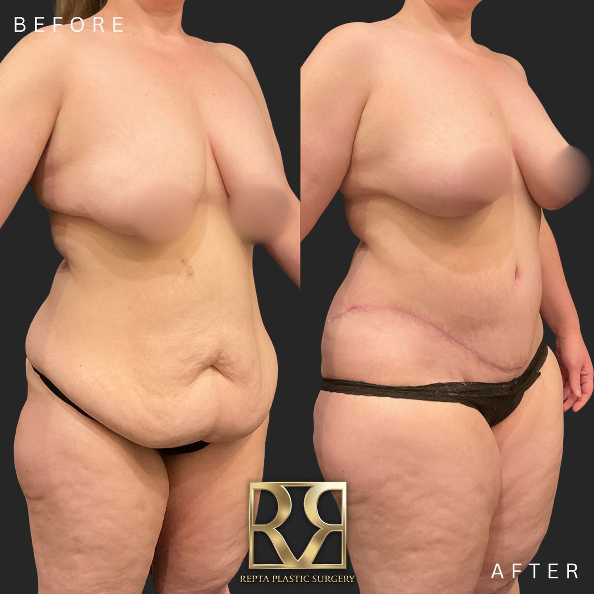 DrRepta's tweet photo. A tummy tuck isn't simply about making the stomach smaller.

The goal is to create a balanced abdominal contour by addressing the areas that need it, which can include excess skin, fat, muscle separation and the pubic area. #plasticsurgery #tummytuck https://t.co/VbEWp0cIId