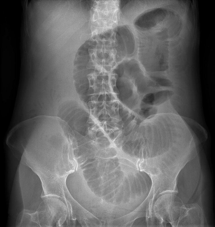 RadMasterclass's tweet photo. X-RAY QUIZ: 24-year-old patient with suspected appendicitis. What does the image show?
A: Caecal volvulus
B: Normal appearances
C: Pneumoperitoneum
D: Small bowel obstruction
E: Toxic megacolon
Start Quiz https://t.co/YfAknCatxy https://t.co/fszBhihe0I