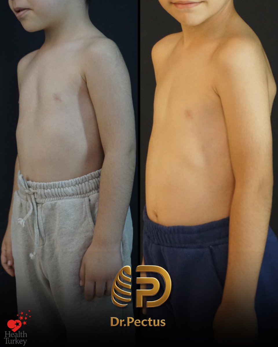 drpektus's tweet photo. ✨ At the end of a 3-year non-surgical treatment journey…

Our journey with our patient began in November 2023. At the initial evaluation, the pectus excavatum depth was measured at 1 cm, and treatment with a 9 cm vacuum bell was planned. https://t.co/50ZihHPlGS