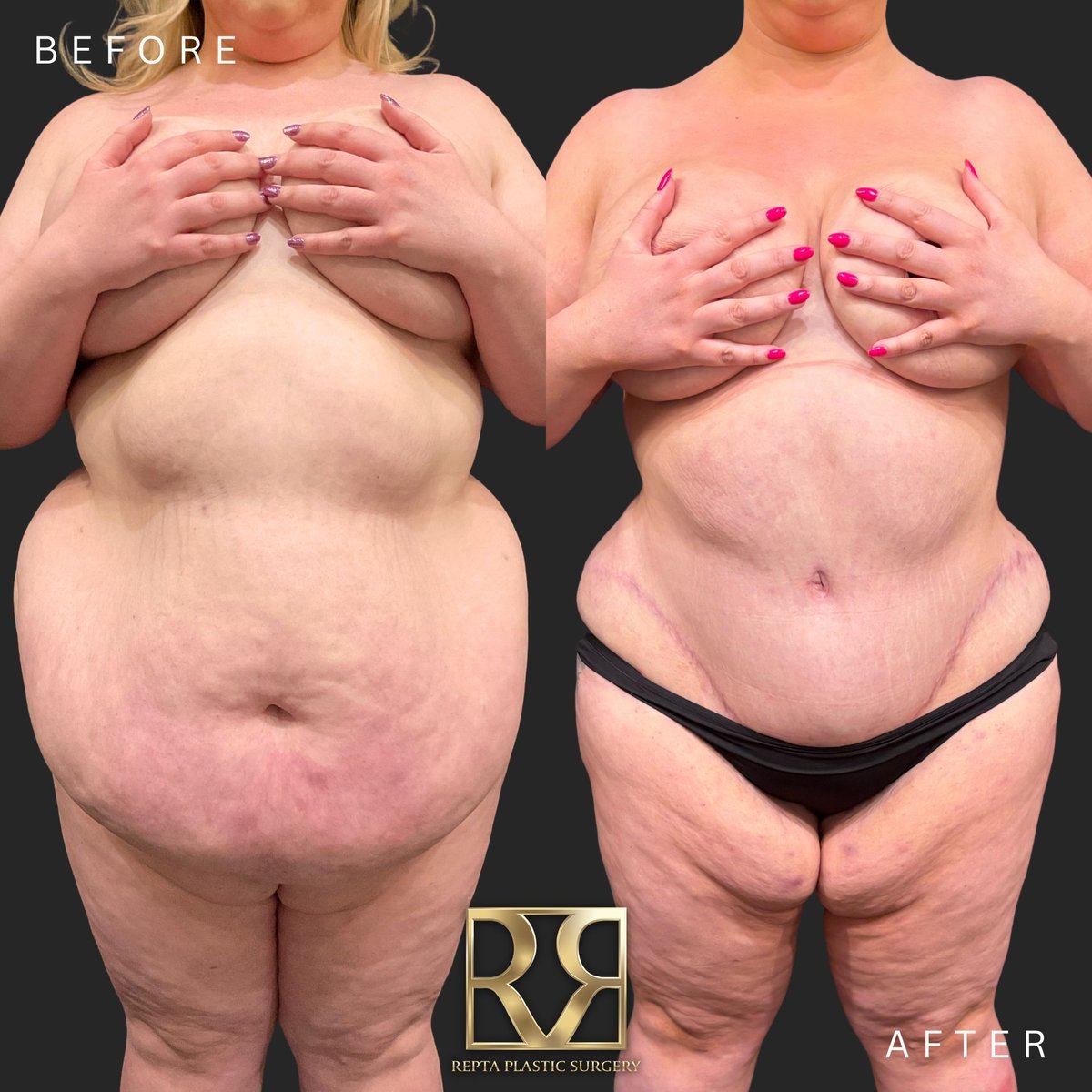 DrRepta's tweet photo. MYTH: Liposuction and a tummy tuck do the same thing.

Liposuction removes excess fat. A tummy tuck addresses excess skin and can also address the abdominal wall.

They can sometimes be combined, but they serve different purposes.

#Liposuction #TummyTuck https://t.co/8y3JmuOgPH