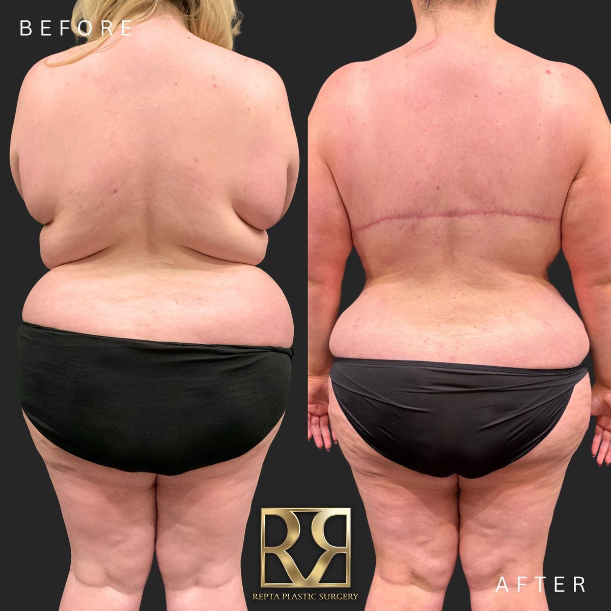 DrRepta's tweet photo. MYTH: Liposuction and a tummy tuck do the same thing.

Liposuction removes excess fat. A tummy tuck addresses excess skin and can also address the abdominal wall.

They can sometimes be combined, but they serve different purposes.

#Liposuction #TummyTuck https://t.co/8y3JmuOgPH