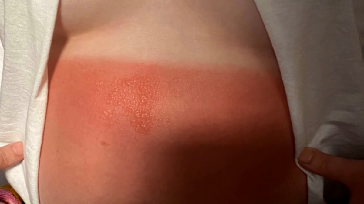 A close-up image shows a severe sunburn across a woman's chest and upper torso, with visible blistering and peeling skin, corresponding to the sneak peek of a "ER: Caught on Camera" episode where a woman's extreme sunburn lands her in the burn unit.