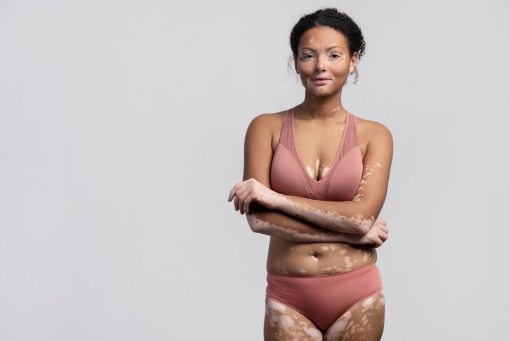 LugonesEditor's tweet photo. Estos resultados respaldan el potencial de povorcitinib como estrategia sistémica dirigida para el tratamiento del vitiligo no segmentario extenso, actualmente en evaluación en estudios globales de fase 3. 

Leé la nota completa en: https://t.co/8krWQt97iG https://t.co/tpIuPoq32M