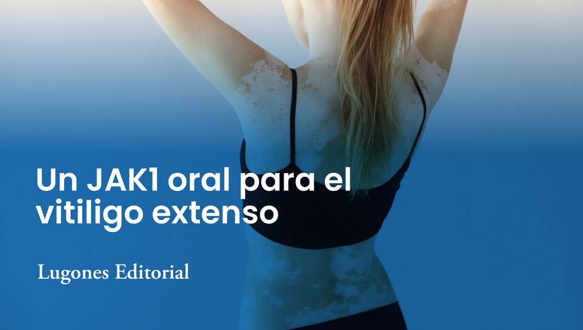 LugonesEditor's tweet photo. Un JAK1 oral para el vitiligo extenso

[ABRIMOS HILO]

Leé la nota completa en: https://t.co/8krWQt8zt8

#vitiligo #vitiligoawareness #dermatologia https://t.co/4A6PthPmPn