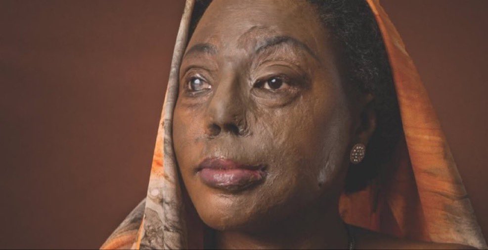 MeddieMambo's tweet photo. Years ago, she was interviewed by mamito, @JustineNameere, on NTV’s Real Life Stories. Her story was told, the attention faded and life moved on as though nothing had happened, yet justice was never served.
Today, that needs to change. Hanifah Nakiryowa deserves justice.
#JusticeForHanifah