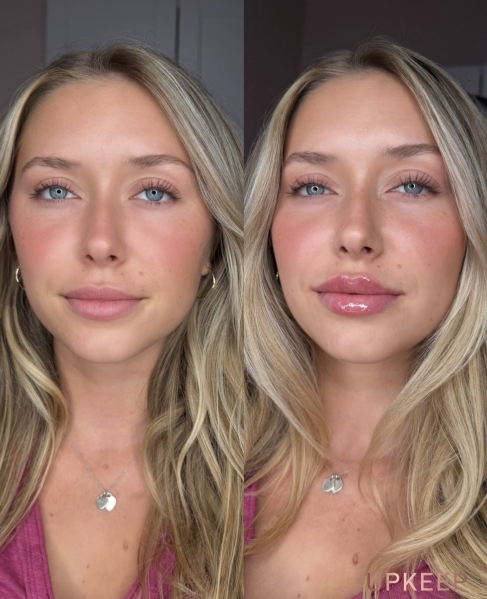UPKEEPMEDSPA's tweet photo. A little volume, a lovely refresh. 💋 

See this UPKEEP Quick Lips® before &amp; after, then book your half syringe lip filler treatment for $75 OFF through October 9! https://t.co/E215qBrYlc

#UPKEEPMedSpa #QuickLips #LipFiller https://t.co/rLDJ6QzOTN