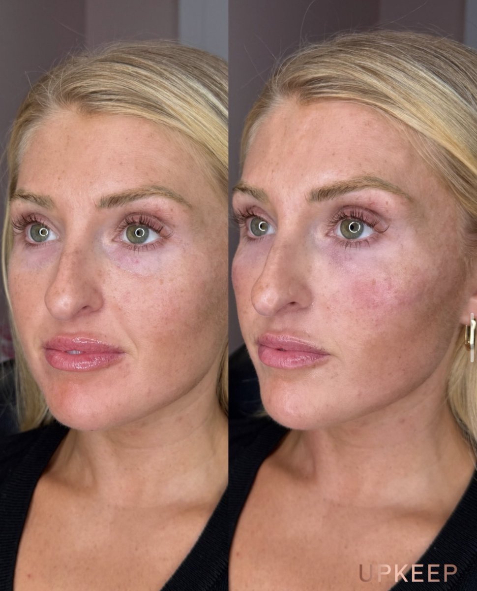UPKEEPMEDSPA's tweet photo. A little cheek love, a little under-eye refresh. ✨

Explore cheek filler and under-eye filler at UPKEEP Med Spa with a treatment plan tailored to your features and goals.

Book a consultation https://t.co/E215qBswaK

#UPKEEPMedSpa #CheekFiller #UnderEyeFiller https://t.co/eXlkv3AZzD