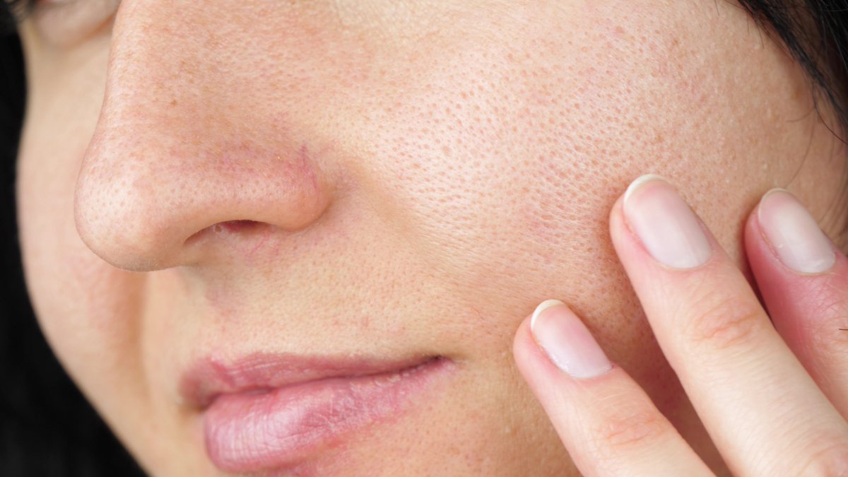 Practical_Derm's tweet photo. 🌿 EARLY ENVIRONMENTAL FACTORS FOR AD: Environmental factors may play an important role in pediatric atopic dermatitis, according to new research ➡️ https://t.co/zV1NB4IES8 #AtopicDermatitis #PediatricDermatology #Dermatology #Eczema https://t.co/2ScrG1ASNW
