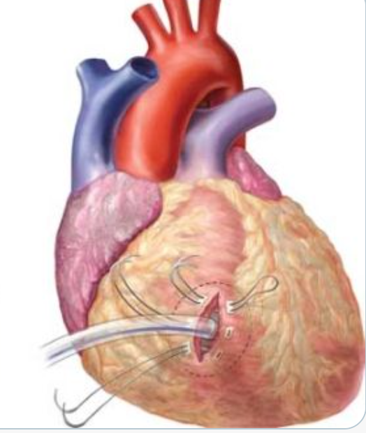 rbarbosa91's tweet photo. Many of my followers are urologists, and I'm talking with some of them this week, so I thought they might appreciate one of my early 🧵on the novel ways that Foley catheters have been used *other than* for draining the bladder.  🧐 https://t.co/b7IeBqGl6I