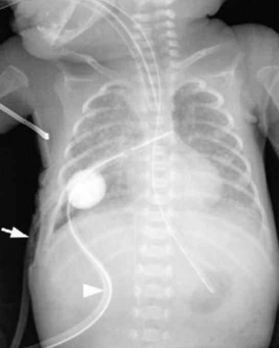 rbarbosa91's tweet photo. Many of my followers are urologists, and I'm talking with some of them this week, so I thought they might appreciate one of my early 🧵on the novel ways that Foley catheters have been used *other than* for draining the bladder.  🧐 https://t.co/b7IeBqGl6I