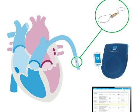 Kennedyyraye's tweet photo. Medical devices are becoming more connected to everyday care.

Abbott’s updated CardioMEMS system allows heart failure patients to view their pulmonary artery pressure trends through a smartphone app, supporting more proactive and personalized care.

#MedTech #MedicalDevices https://t.co/Bj7ABQQkdG