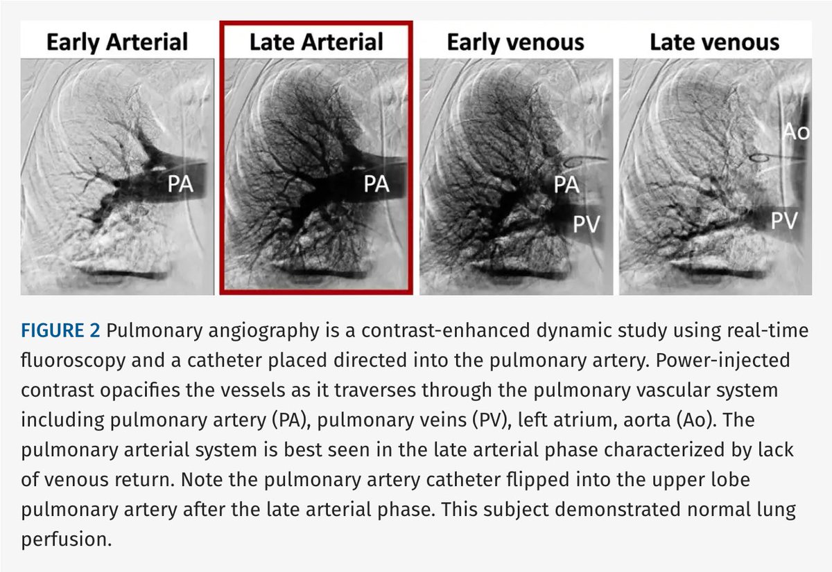 JTIJournal's tweet photo. 🫁 Noncontrast X-ray pulsatility index (XPI) shows promise for pulmonary perfusion imaging in #CTEPH

🩻 In 18 lungs, showed substantial agreement with pulmonary angiography (Dice 0.70).
💨 8-sec breath-hold
💉 No IV contrast
📉 Lower radiation than DSA

#JTI article 🔗 in reply! https://t.co/J1TIoXMnNS