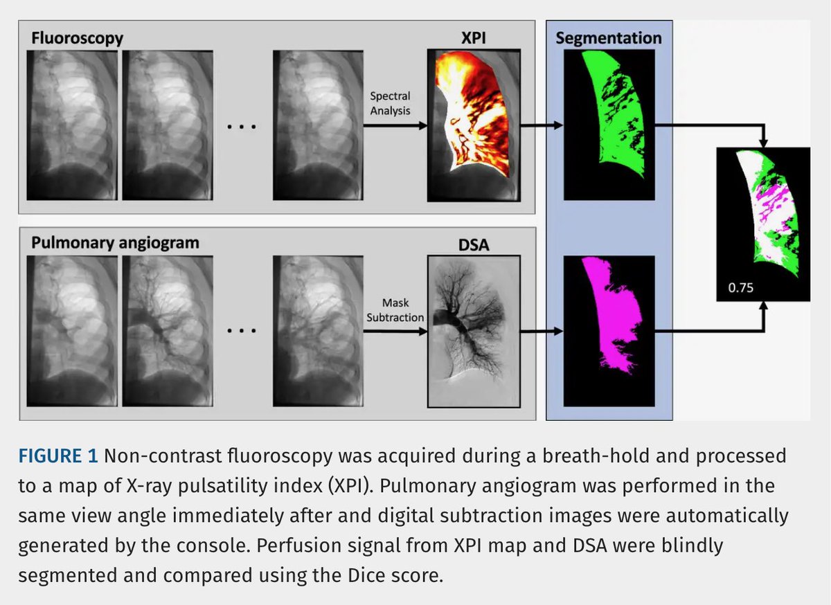 JTIJournal's tweet photo. 🫁 Noncontrast X-ray pulsatility index (XPI) shows promise for pulmonary perfusion imaging in #CTEPH

🩻 In 18 lungs, showed substantial agreement with pulmonary angiography (Dice 0.70).
💨 8-sec breath-hold
💉 No IV contrast
📉 Lower radiation than DSA

#JTI article 🔗 in reply! https://t.co/J1TIoXMnNS