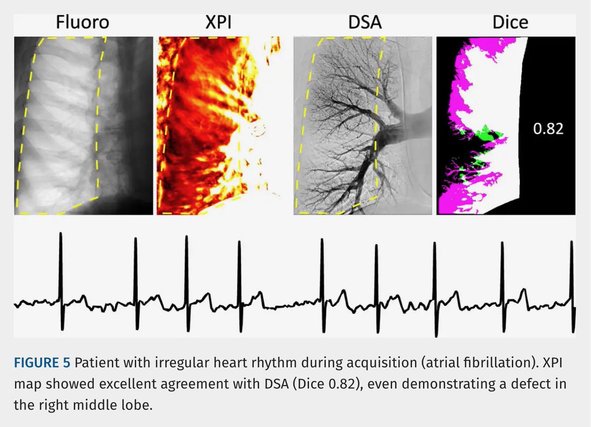 JTIJournal's tweet photo. 🫁 Noncontrast X-ray pulsatility index (XPI) shows promise for pulmonary perfusion imaging in #CTEPH

🩻 In 18 lungs, showed substantial agreement with pulmonary angiography (Dice 0.70).
💨 8-sec breath-hold
💉 No IV contrast
📉 Lower radiation than DSA

#JTI article 🔗 in reply! https://t.co/J1TIoXMnNS