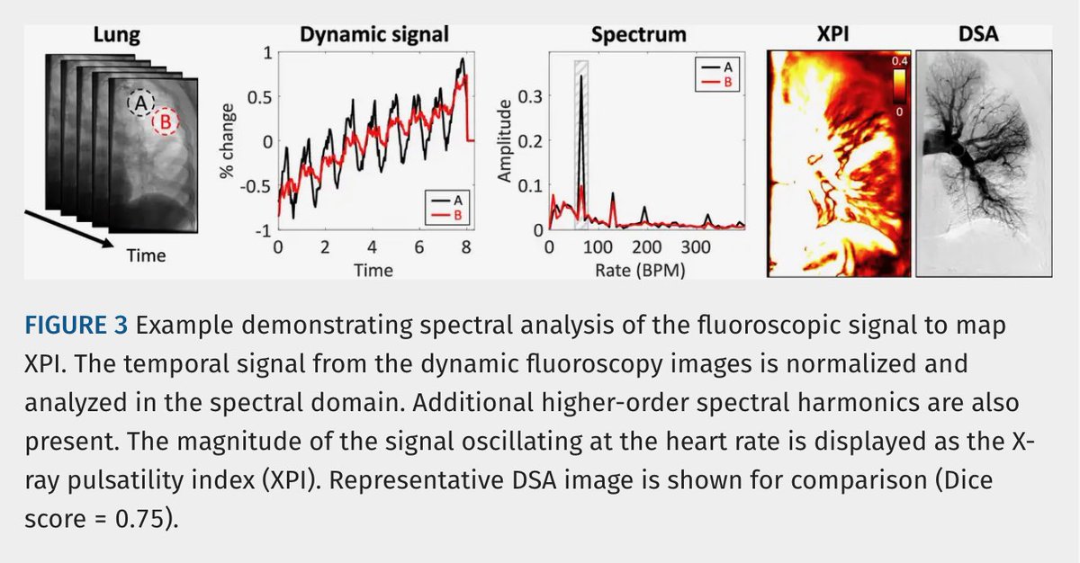 JTIJournal's tweet photo. 🫁 Noncontrast X-ray pulsatility index (XPI) shows promise for pulmonary perfusion imaging in #CTEPH

🩻 In 18 lungs, showed substantial agreement with pulmonary angiography (Dice 0.70).
💨 8-sec breath-hold
💉 No IV contrast
📉 Lower radiation than DSA

#JTI article 🔗 in reply! https://t.co/J1TIoXMnNS