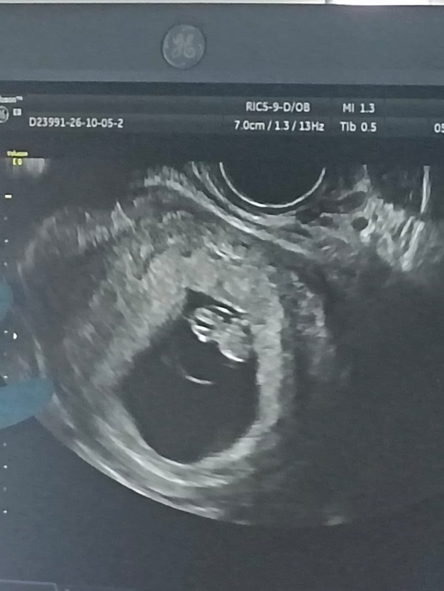 derechoavivir's tweet photo. Qué necesarios somos❤️
Hoy hemos recibido en nuestro local a dos mamás  que después de estar en el abortorio a por información para abortar han venido a vernos  y han decidido tener a sus hijos.

Sin duda escuchar el corazón de sus hijos cambia todo.
Después de acompañarlas a una ecografía, hemos podido hablar con ellas, escuchar sus historias y compartir un momento muy especial, decir Sí a la Vida de sus hijos.
Hay que estar en El Refugio y dar la posibilidad a la Vida!

En la foto  con 8 semanas de gestación, y en el vídeo las risas después de oír su corazoncito: