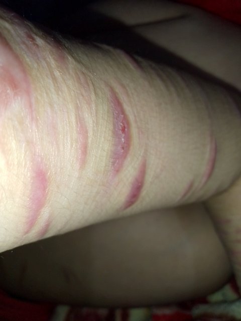 Dogsaresamu's tweet photo. Finally fully healed. At least soo close to It
#scarspo #shedtwt 
#scar #988twt #988 im having more suicidal thoughts than usual too, may be a sign https://t.co/mG5leUb54Z