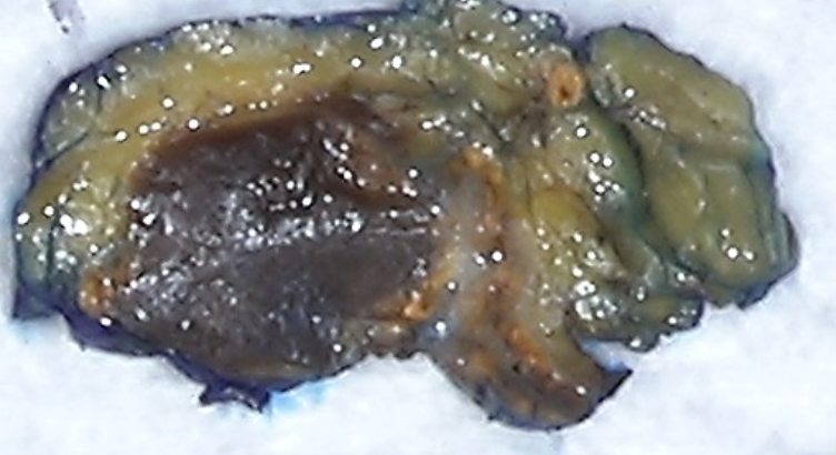 slusagar's tweet photo. #GUpath #endopath #grosspath #beautyinb9
adrenal gland myelolipoma https://t.co/AbiZRX83zK