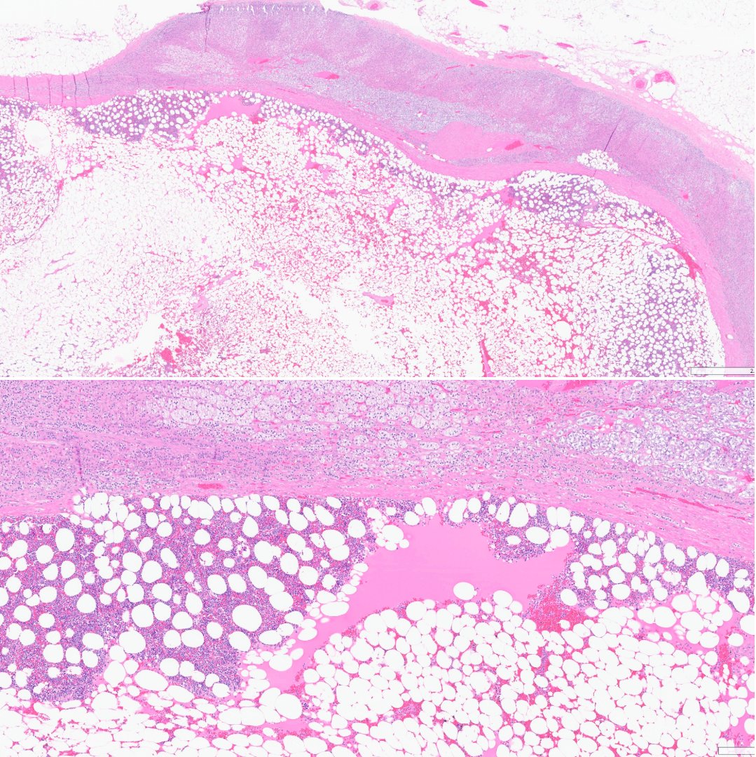 slusagar's tweet photo. #GUpath #endopath #grosspath #beautyinb9
adrenal gland myelolipoma https://t.co/AbiZRX83zK