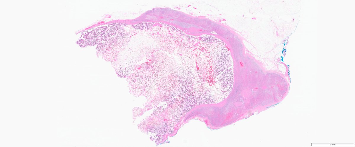 slusagar's tweet photo. #GUpath #endopath #grosspath #beautyinb9
adrenal gland myelolipoma https://t.co/AbiZRX83zK