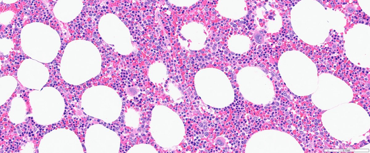 slusagar's tweet photo. #GUpath #endopath #grosspath #beautyinb9
adrenal gland myelolipoma https://t.co/AbiZRX83zK