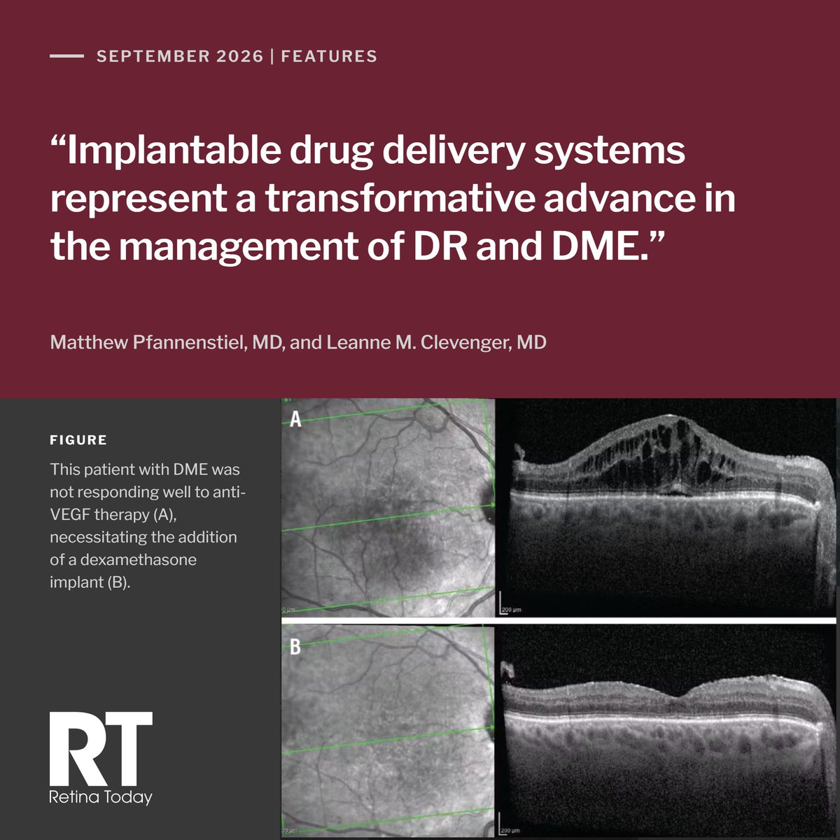 RetinaToday's tweet photo. When anti-VEGF therapy isn't enough for DME, what comes next? Drs. Pfannenstiel and Clevenger review approved and emerging implant-based treatments for diabetic retinopathy and diabetic macular edema. https://t.co/Gntx5sbe8Z #Retina #DME https://t.co/fDCsyZDG0Y