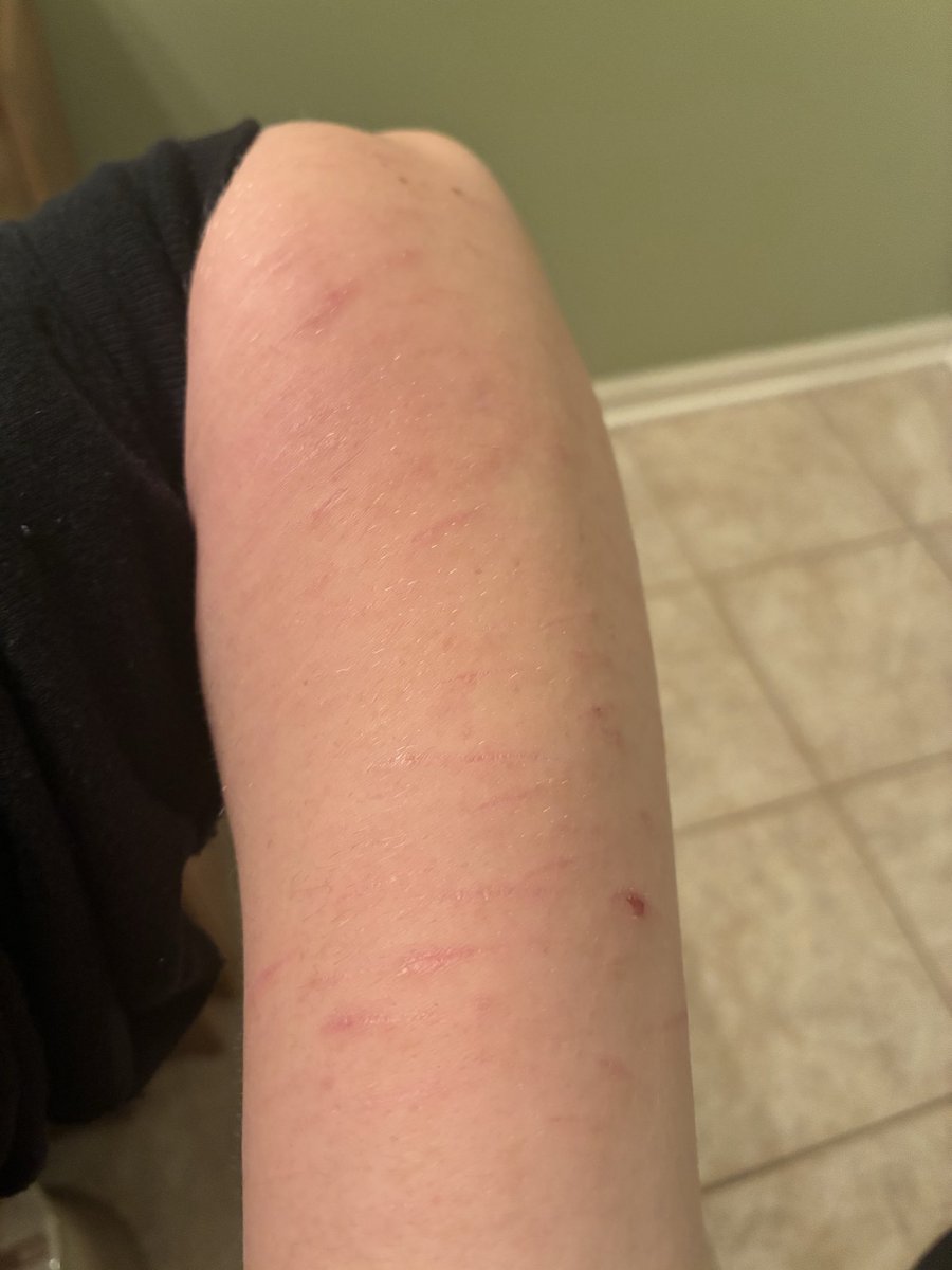 Curry29Dani's tweet photo. Scarspo?? No? Ok my fat chud will shut up. Fake sfx makeup made by ai btw.  #scarspo #shtwt #scars #sh #shrtwt #edtwt https://t.co/dHIyttmSIF