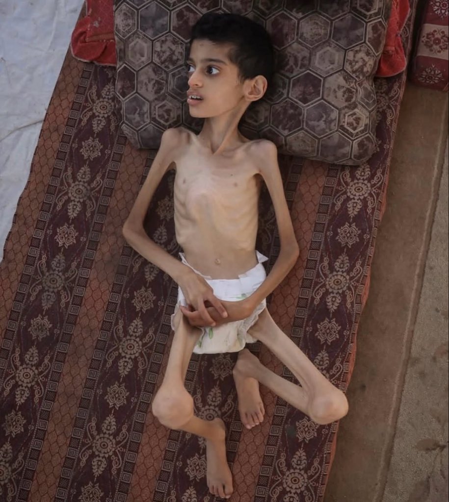 shams_omar2003's tweet photo. Please help the children of Gaza. 💔🇵🇸 They are suffering terribly—many are facing hunger, illness, displacement, and the heartbreaking loss of loved ones. No child should have to endure this kind of suffering. #Gaza #GazaUnderAttack #freepalestine #FreeGaza #GazaChildren #Gaza https://t.co/C3RLp5td0o