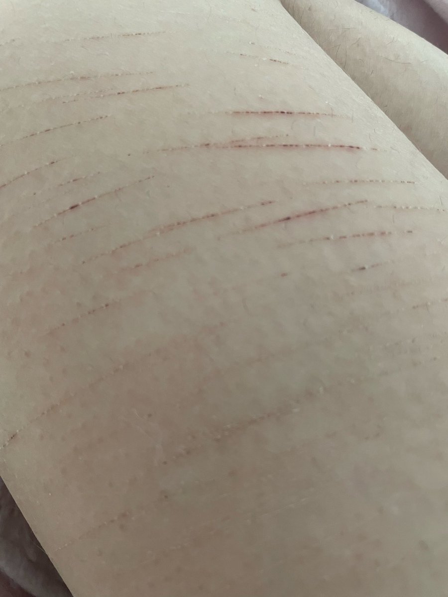 lohenforever's tweet photo. (kinda) old cat scratches!! : D 

⚠️ SFX MAKEUP, NOT REAL! ⚠️

#shdtwt #selfharm #shedtwt https://t.co/ffolgCo2YZ