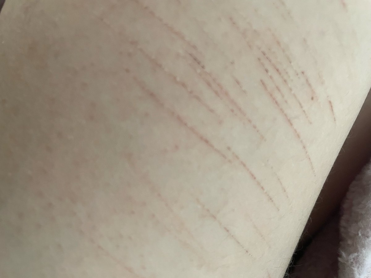 lohenforever's tweet photo. (kinda) old cat scratches!! : D 

⚠️ SFX MAKEUP, NOT REAL! ⚠️

#shdtwt #selfharm #shedtwt https://t.co/ffolgCo2YZ