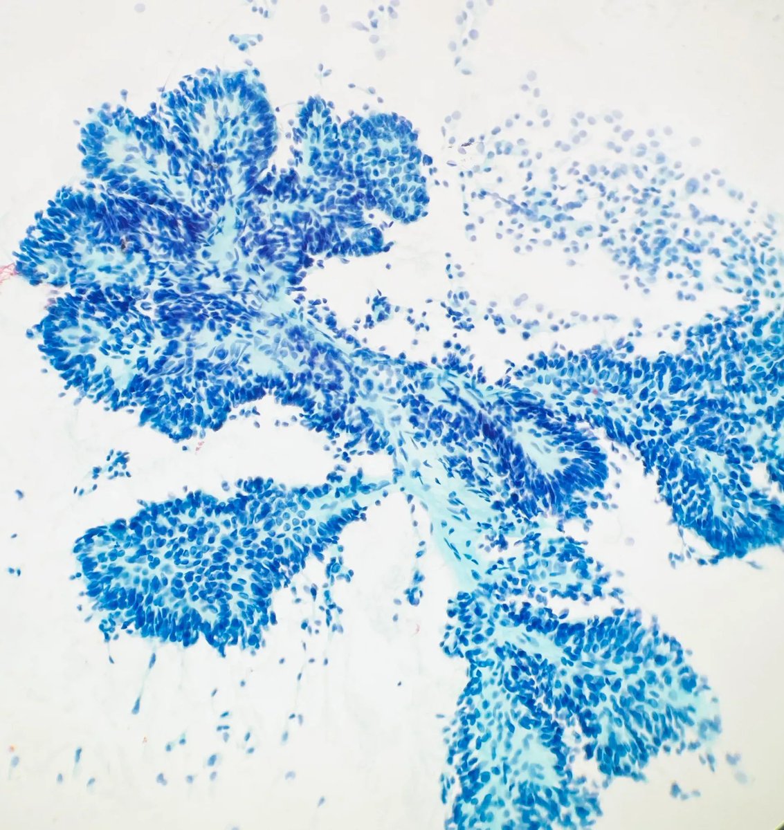Gloria_SuraMD's tweet photo. Fine needle aspiration of a thyroid nodule revealing arborizing papillae of tumor cells. What is the diagnosis? Answer: https://t.co/9x1qWpLT1U #PathArt #CytoPath #PathTwitter #MedTwitter #Cytology https://t.co/q6Az5UJgZe https://t.co/S6QGHOHyTX