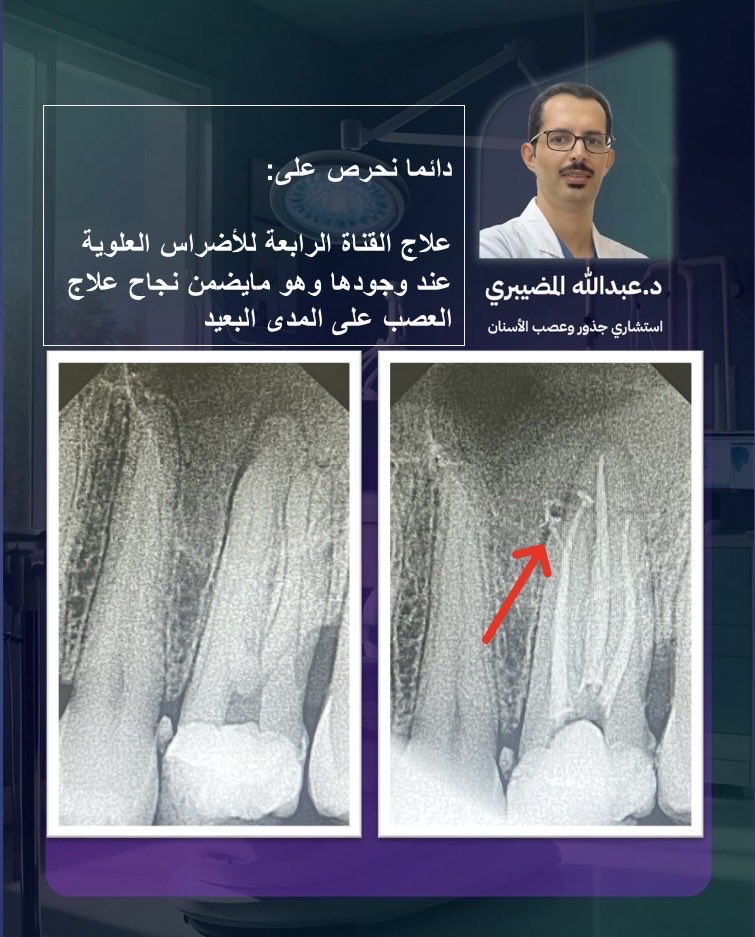 drendoabdullah's tweet photo. بعد علاج الأضراس العلوية قد يعود الألم مع مرور الوقت،  لوجود قناة رابعة لم يتم اكتشافها وعلاجها

لذلك نحرص في عيادتنا على اكتشاف جميع القنوات وعلاجها بدقة، لأن نجاح علاج العصب على المدى البعيد يبدأ من علاجها بالشكل الصحيح.

عيادات بيرل 
الرياض - الازدهار

0535491621
0556134619 https://t.co/RpXsd5f4ij