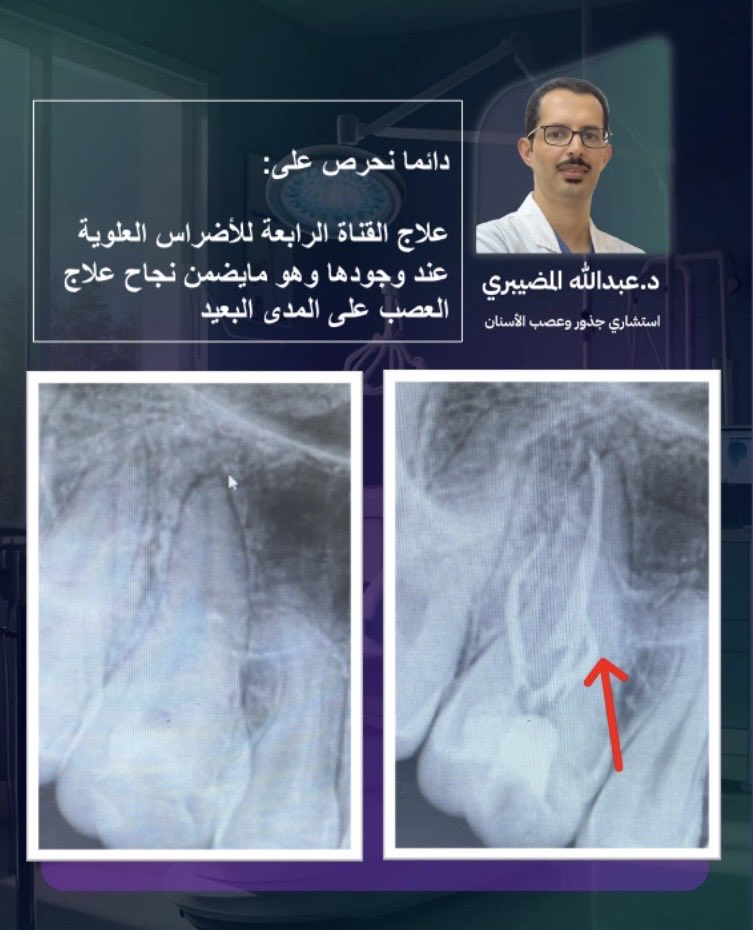 drendoabdullah's tweet photo. بعد علاج الأضراس العلوية قد يعود الألم مع مرور الوقت،  لوجود قناة رابعة لم يتم اكتشافها وعلاجها

لذلك نحرص في عيادتنا على اكتشاف جميع القنوات وعلاجها بدقة، لأن نجاح علاج العصب على المدى البعيد يبدأ من علاجها بالشكل الصحيح.

عيادات بيرل 
الرياض - الازدهار

0535491621
0556134619 https://t.co/RpXsd5f4ij
