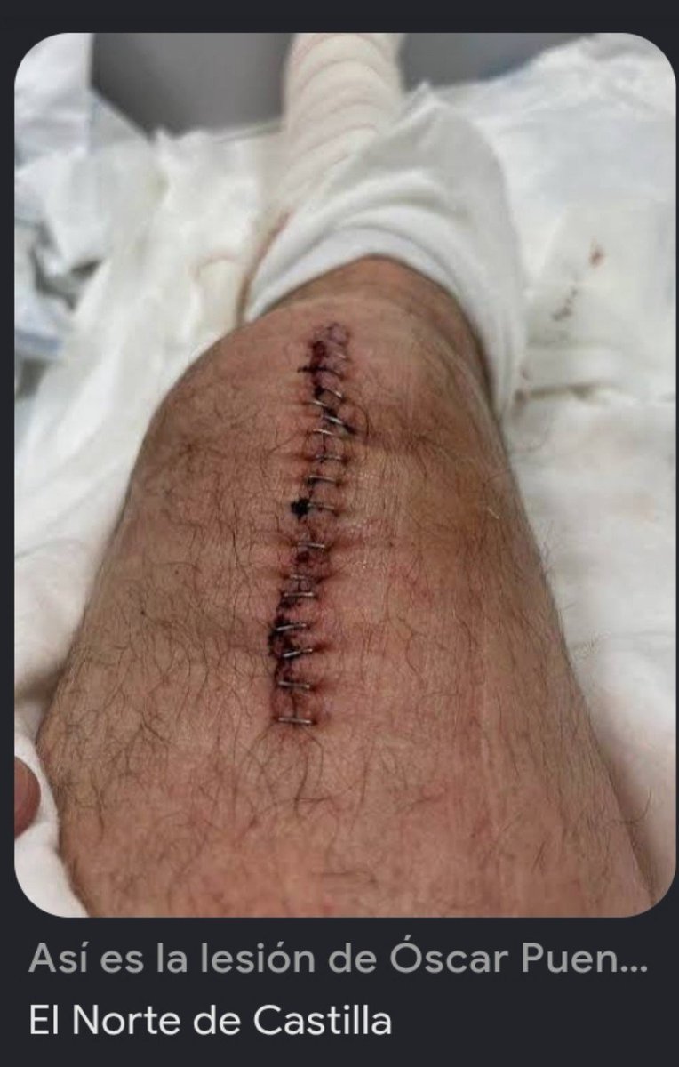 enseguida003's tweet photo. @ppopular @oscar_puente_ tuvo (en precampaña) una rotura del tendón del cuádriceps en la pierna derecha, no un esguince.
Estuvo ingresado un día, recibió el alta hospitalaria al siguiente y estuvo de baja 5 meses.
Feijóo se saltó la campaña electoral por un lumbago. ¿Quién es más cagón? https://t.co/e0vBu1PK9r