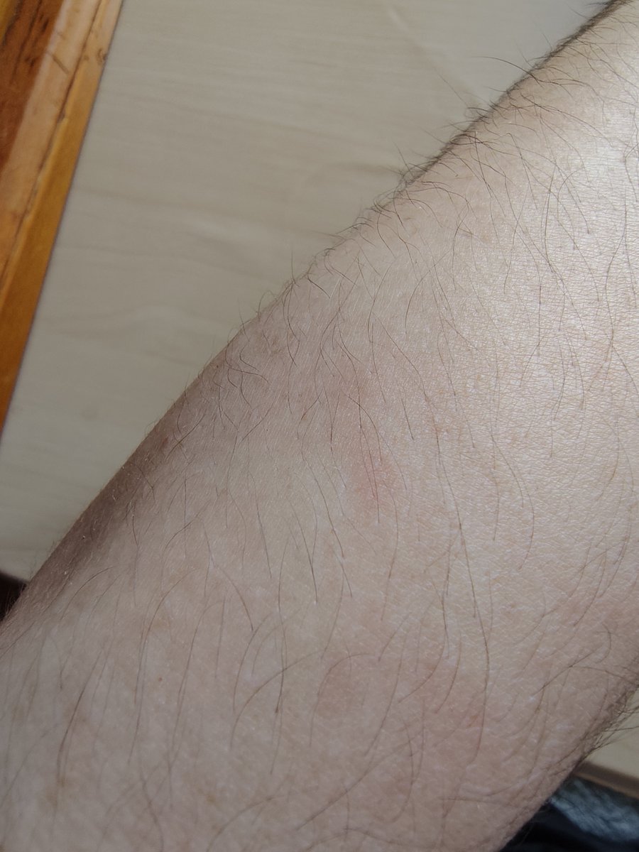 nekopopn's tweet photo. 初めてスズメバチ？に刺されました。急いで水で洗ったからそんなに腫れてない、痛いけど。蜂怖いよ🐝 https://t.co/zXPkQIu9d7