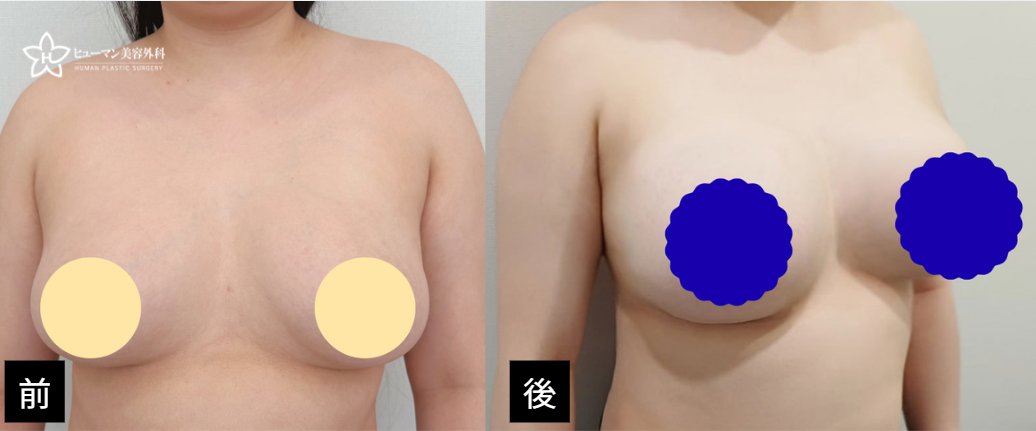 humanpsjp's tweet photo. 【ヒューマン美容外科｜豊胸症例】

豊胸再手術｜キム・グクヒョン代表院長

モティバ300ccからメンター・ブースト530ccへ豊胸再手術✨
両側のサイズ調整に加え、乳房下縁切開・傷跡除去・被膜形成術・被膜除去を行いました。

📩 LINE：humansjp

📷 症例の詳細はこちら
https://t.co/6HerKdAxXZ https://t.co/Df077z98A5
