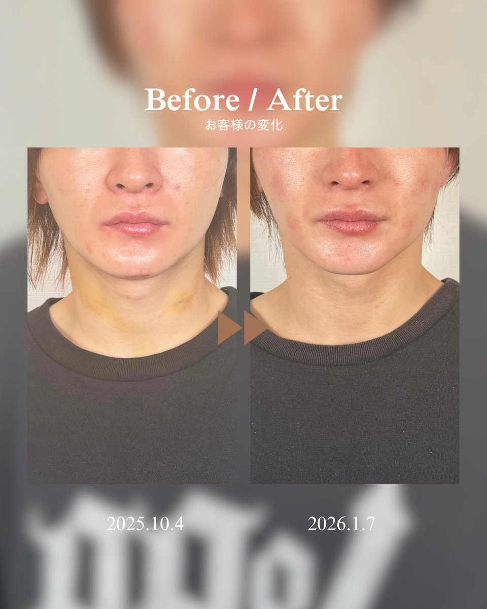 INDIBA_OnpaLabo's tweet photo. 「顎下のもたつき、ここまで変わる？」

今回は【顎下脂肪吸引＋ペリカン】の症例。

クリニック：  LUHO美容外科 様　
手術部位：顎下脂肪吸引 ペリカン手術

正面から見ると顎下〜首の境目がすっきりし、横顔ではフェイスラインから首にかけてのラインがより明瞭に。 https://t.co/NjIfDxLG3y