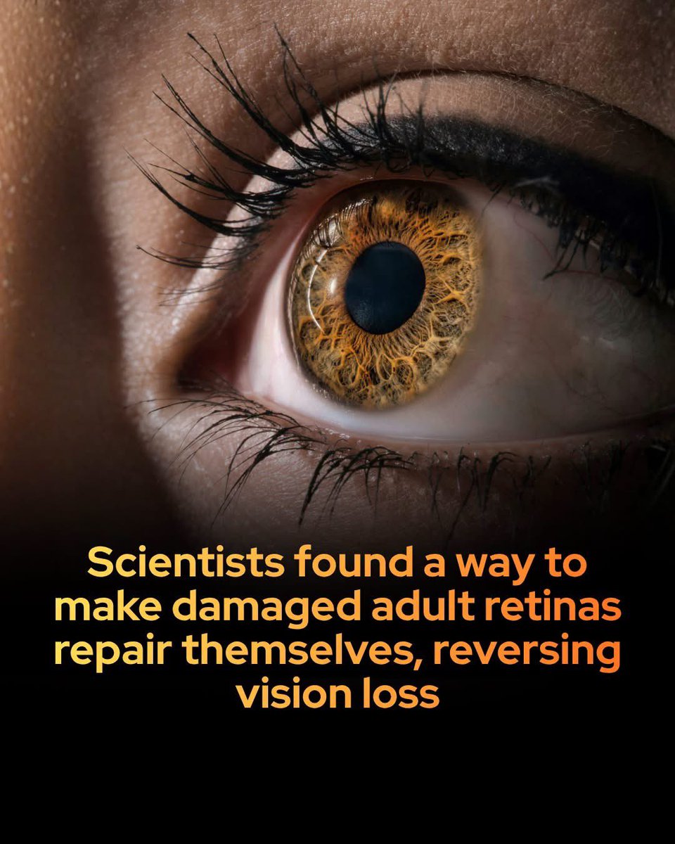 SmartScience's tweet photo. In a medical first, scientists triggered a self-repair mechanism in damaged adult retinas, successfully reversing vision loss .

For decades, science has operated under the assumption that once the adult mammalian retina is damaged, vision loss is permanent. 

Unlike fish or birds, which can naturally regenerate eye tissue, humans and other mammals have lacked the biological tools to repair these delicate neural pathways. However, a groundbreaking study by researchers at the Michigan State University College of Veterinary Medicine has shattered this dogma.

 Using a single-dose gene therapy in adult dogs suffering from an inherited form of blindness, the team did not just stop the progression of the disease—they witnessed the eye's physical structure actively rebuilding its own neural connections.

The therapy targets a mutation in the CaBP4 gene, which controls vital calcium signaling between light-sensing cells and the brain. Led by assistant professor Billie Beckwith-Cohen and professor Simon Petersen-Jones, the treatment acted like an editor, supplying corrected genetic blueprints. 

Remarkably, the fully developed retinas formed new synaptic connections, thickened, and recovered lost visual function, proving that mature nerve cells retain an unexpected capacity for healing. This discovery opens the door to a new generation of treatments that could one day restore sight to millions of people suffering from complex retinal conditions.

source: Beckwith-Cohen, B., Sun, K., Occelli, L. M., Winkler, P. A., Somma, A. T., Montiani-Ferreira, F., Marinho, L. F. L. P., Schall, P. Z., Parys, M., Yuzbasiyan-Gurkan, V., & Petersen-Jones, S. (2026). Gene therapy induces synaptic ribbon maturation, synaptogenesis and vision recovery in an adult dog model of retinal degeneration. Molecular Therapy Advances.