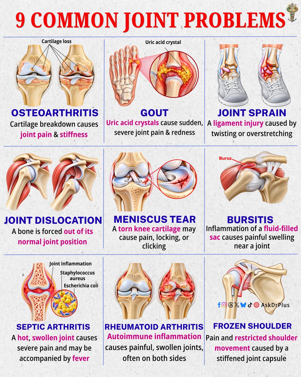 AskDoctorPlus's tweet photo. 9 Common Joint Problems 
#JointHealth #Arthritis #Medical #AskDrPlus #Nursing https://t.co/sVvc4V20Sl