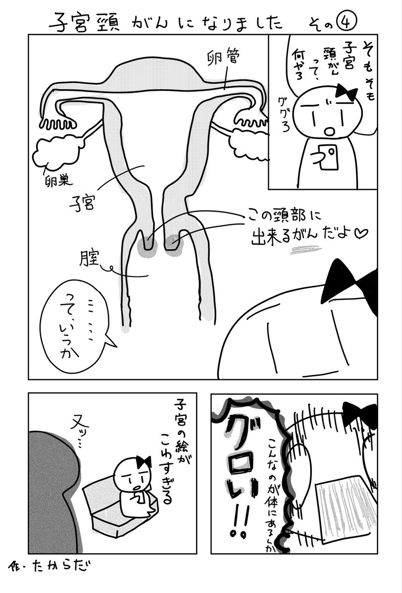 sikyukeigan_oko's tweet photo. 子宮頸がんになりました　その4

※ステージ1a1という癌の超初期でも子宮摘出になったので婦人科検診とワクチン接種のご検討をお願いします。

#子宮頚がん　#婦人科検診 https://t.co/fS2bC8scX8