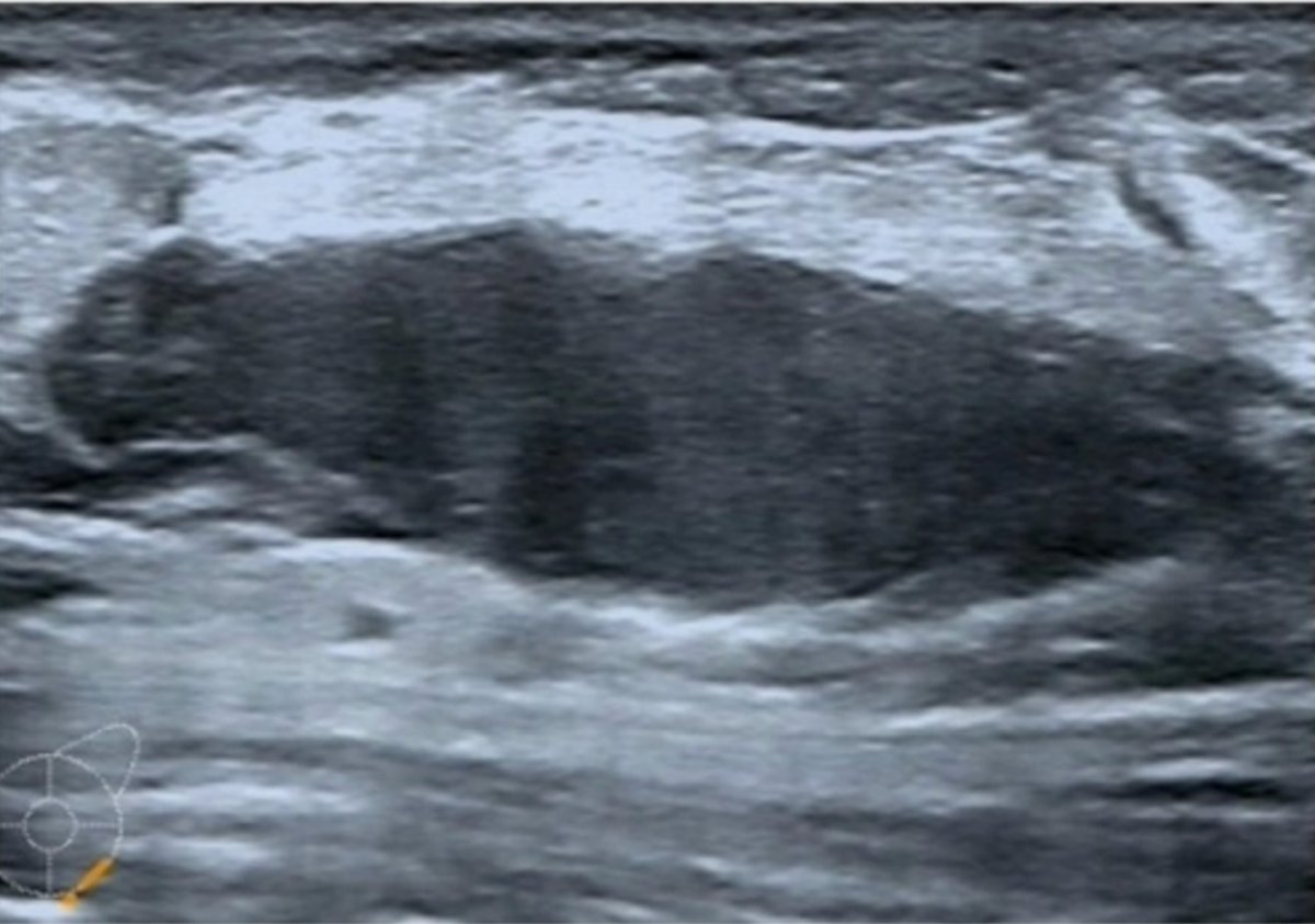 jppathpd's tweet photo. Dx? breast CD34 #Pathkeys https://t.co/d021iWdrTJ