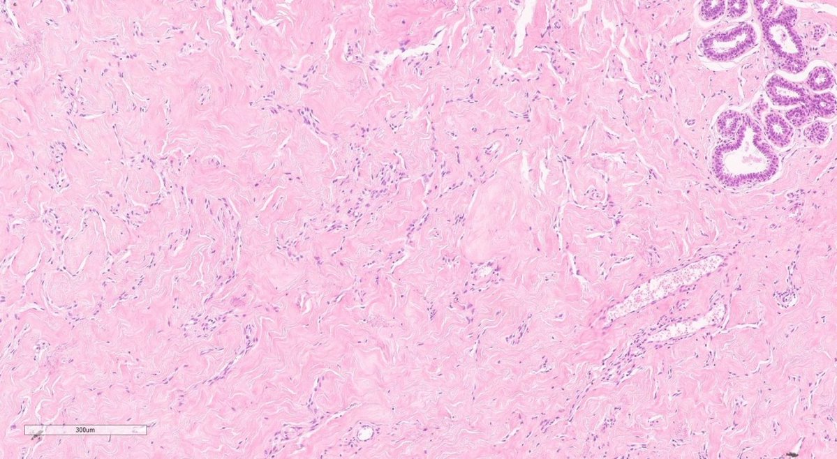 jppathpd's tweet photo. Dx? breast CD34 #Pathkeys https://t.co/d021iWdrTJ