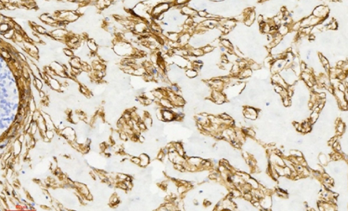 jppathpd's tweet photo. Dx? breast CD34 #Pathkeys https://t.co/d021iWdrTJ