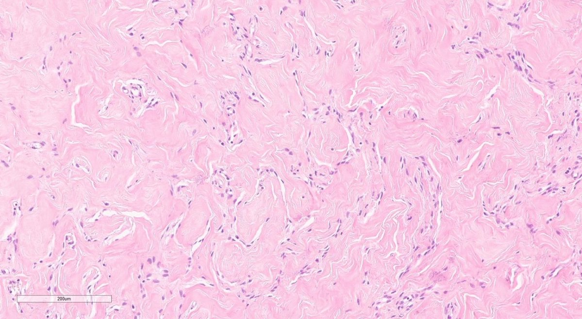 jppathpd's tweet photo. Dx? breast CD34 #Pathkeys https://t.co/d021iWdrTJ