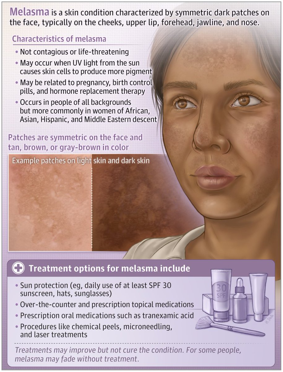 JAMADerm's tweet photo. #Melasma is a skin condition that causes dark patches on the face.  

This JAMA Dermatology Patient Page describes the causes, symptoms, diagnosis, and treatment of melasma. 

https://t.co/Px7eWiNSMb https://t.co/B8icNJyXKK