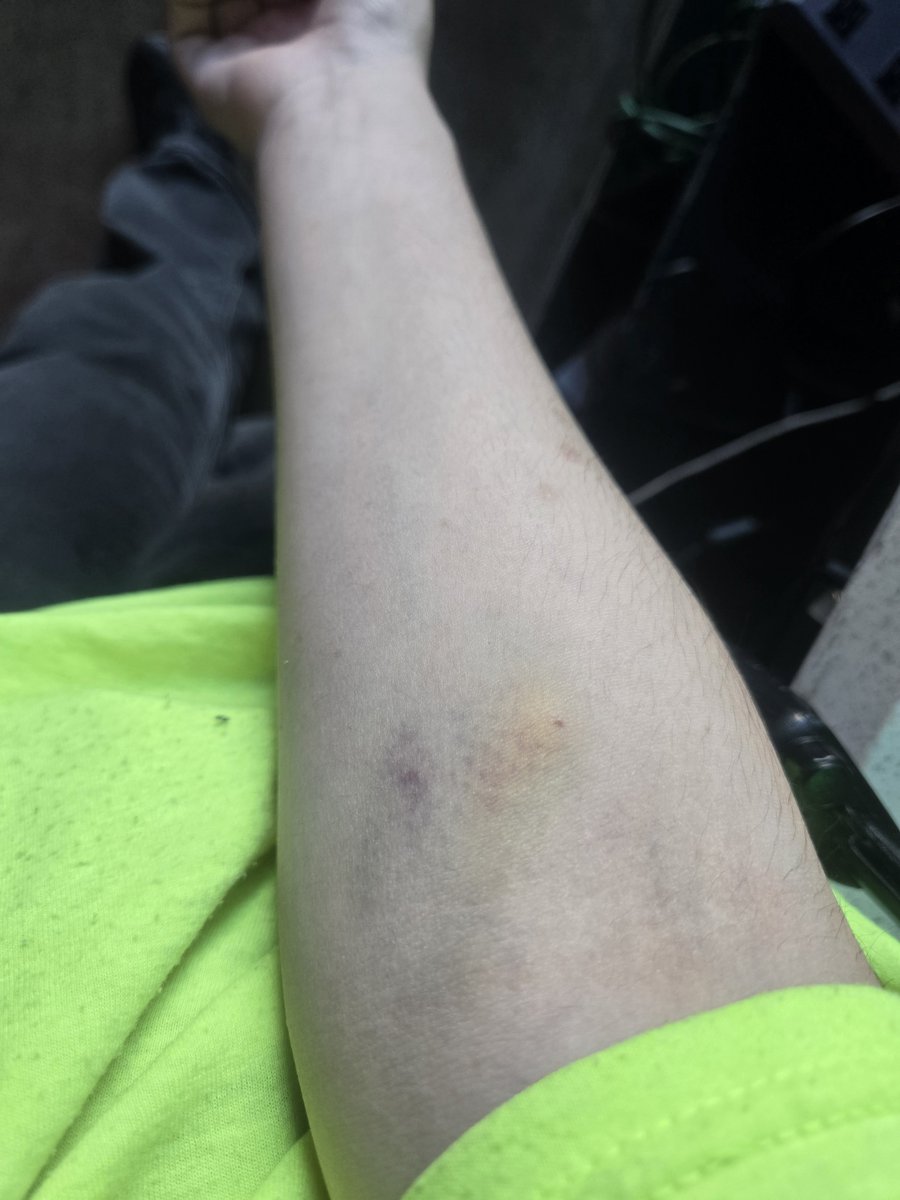 Ending_Ender's tweet photo. Donated blood on Friday, but they could only take 375/500 milliliters because they actually blew a vein and this is the resulting bruising 3 days later 💔 https://t.co/EAXYIEjMce