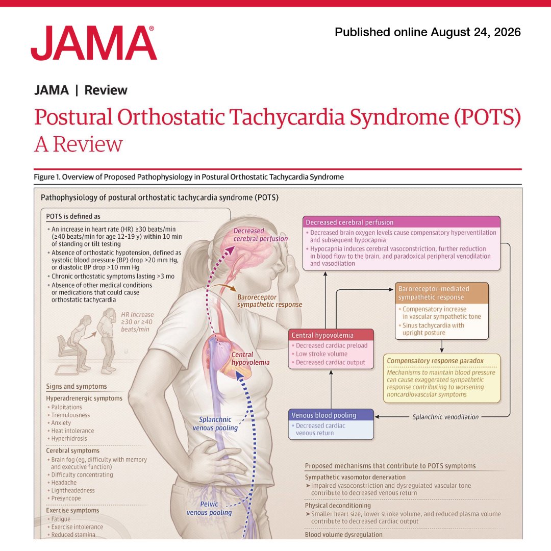 JAMA_current's tweet photo. #PosturalOrthostaticTachycardiaSyndrome (POTS) is a chronic autonomic disorder defined by orthostatic symptoms with a sustained heart rate increase within 10 minutes of standing or head-up tilt, without orthostatic hypotension. 

🔗 https://t.co/8pKW9zMMBc https://t.co/5U4dKhgvzo